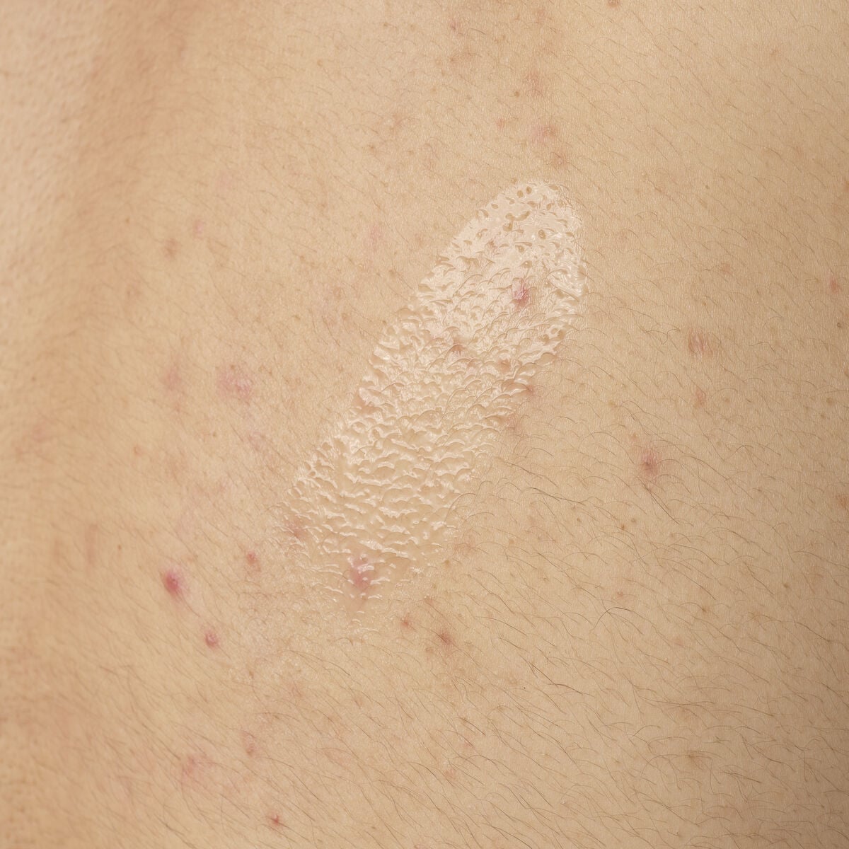 salicylic-acid-0-5-body-serum-t5 ORD-salicylic-acid-05-body-240ml-application.jpg