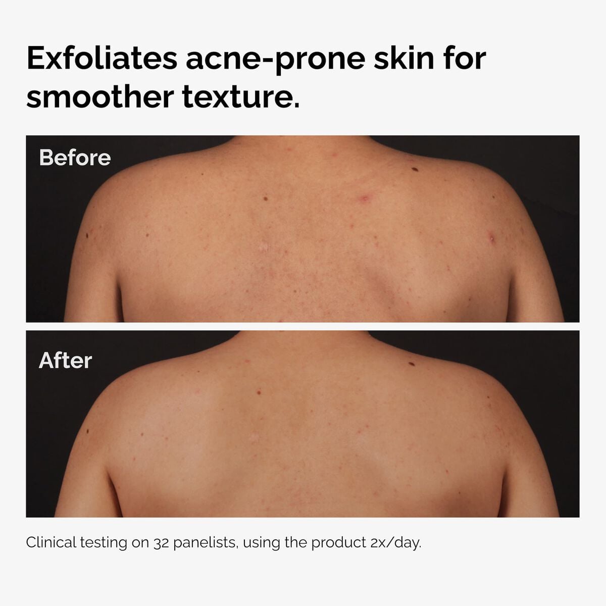salicylic-acid-0-5-body-serum-t5 ord-salicylic-acid-body-serum-before-after-graphic-NA.jpg
