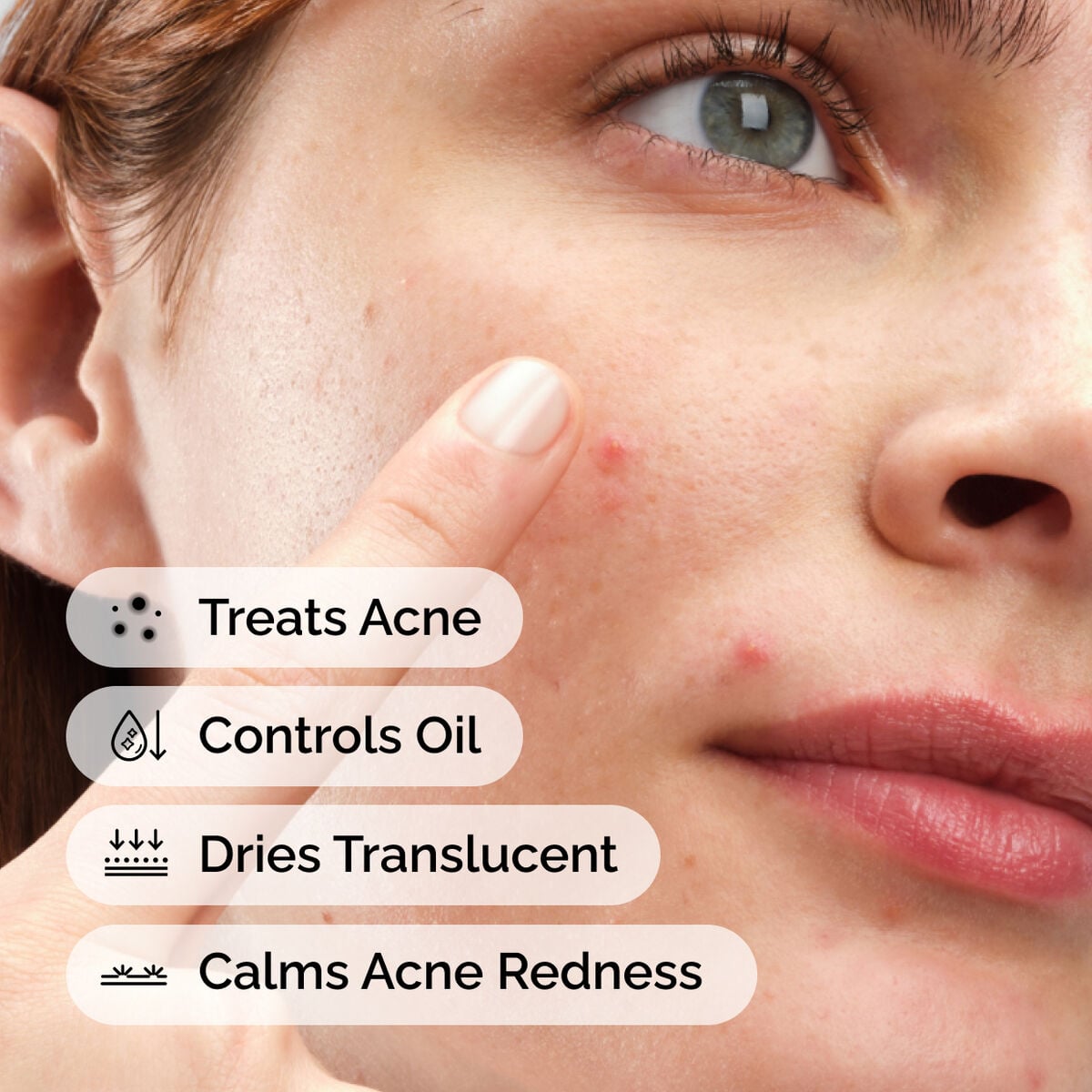sulfur-10-powder-to-cream-concentrate-c1 ord-sulfur-10pct-powder-to-cream-concentrate-model-application-with-benefits-acne.jpg